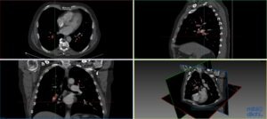 Pulmonary CT