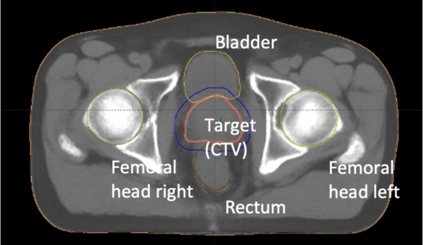 Transversal CT image of the pelvis for radiotherapy planning of a prostate cancer patient.
